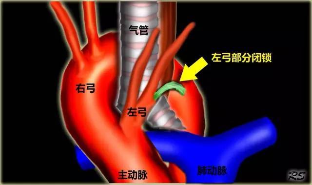 产科疑难超声病例(425):双主动脉弓畸形