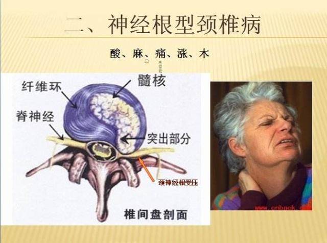 肩膀疼痛 原来不是肩周炎而是神经根型颈椎病