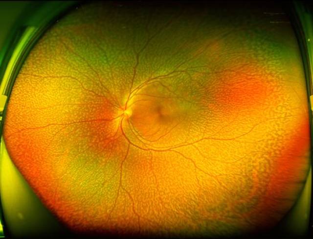 荣耀时刻-中篇∣第三届"精于广·广而精"欧堡超广角眼底影像大赛获奖