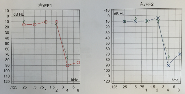 传导性耳聋听力图图片
