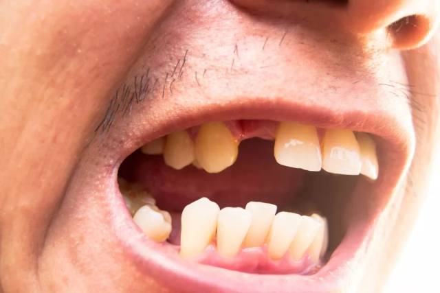 牙周炎有什么症状?牙龈出血→牙龈鼓包,化脓→牙齿松动