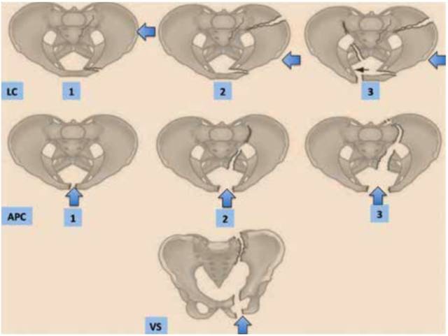 骨盆骨折分类图片