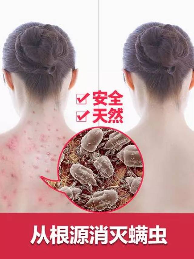 两周不晒被,千万只螨虫在身上爬!教你一招,螨虫彻底消失