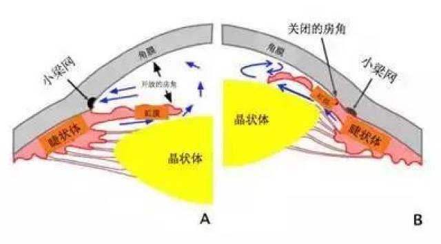 在房水循环途径中任何一环发生阻碍,均可导致眼压升高而引起的病理