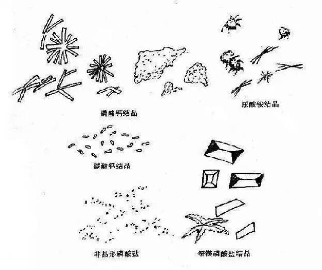 温度改变,代谢紊乱或缺乏抑制晶体沉淀的物质而发生沉淀,形成尿结晶