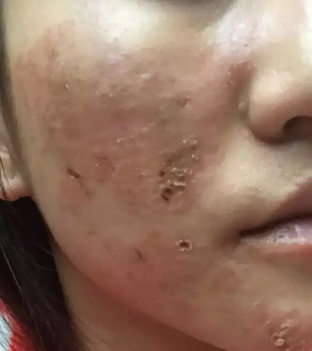 三个月后刘茵的脸冒出很多大痘开始烂脸