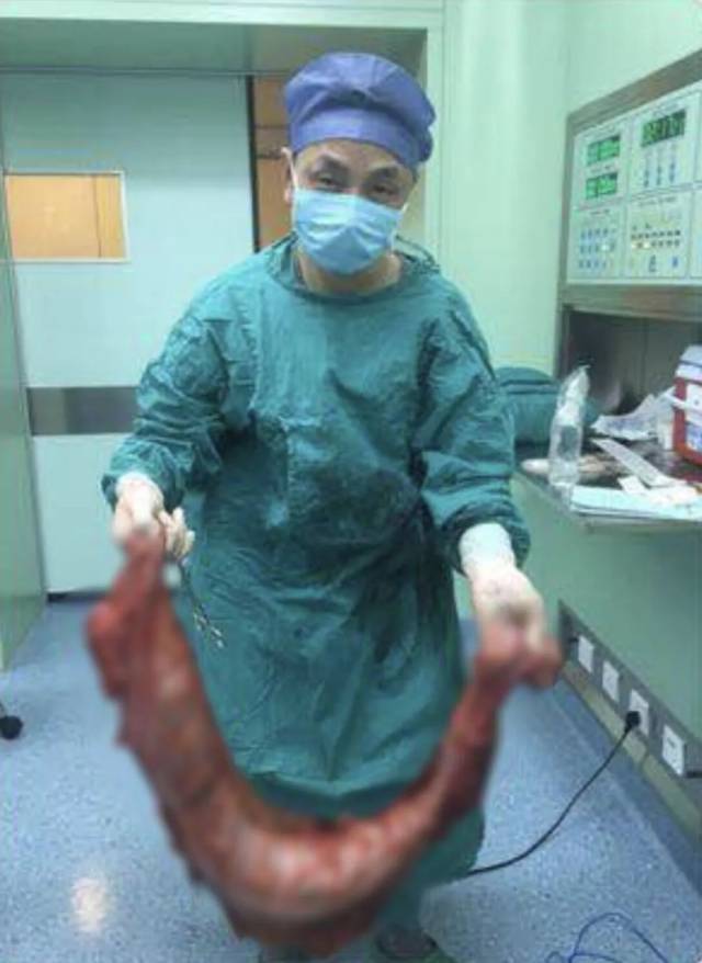 最终,手术切除出长约1米,重达30多斤的大肠