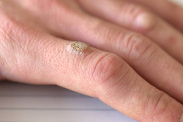 你长的瘊子是公还是母