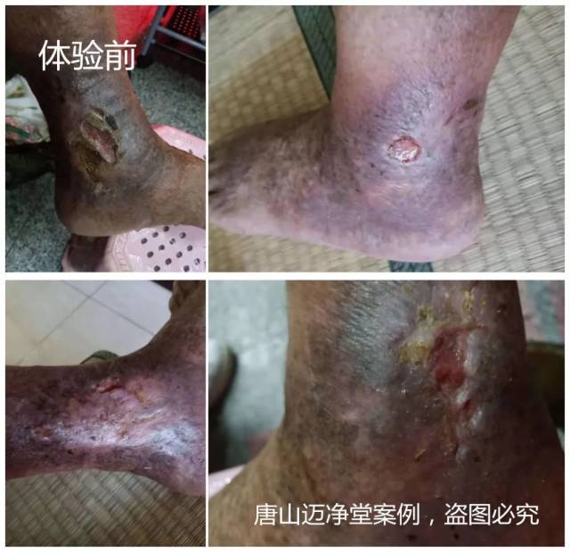 脉管炎老烂腿