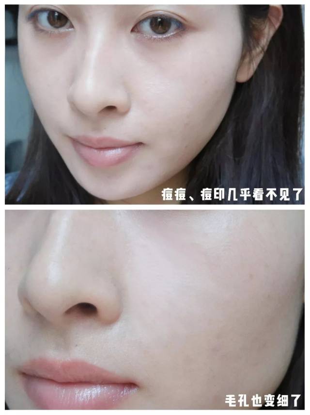 别再激素祛痘做针清了!专业科学的修复法才靠