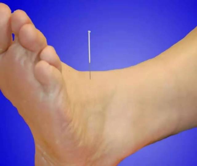 足部针灸位置图图片