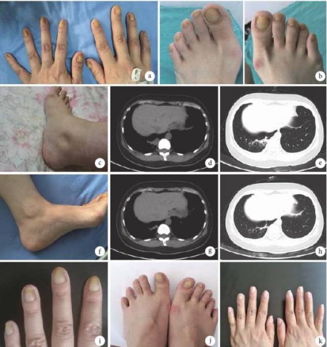图1 患者治疗前后图片 图3 黄甲综合征相关文献 近期罕见病新政策汇总