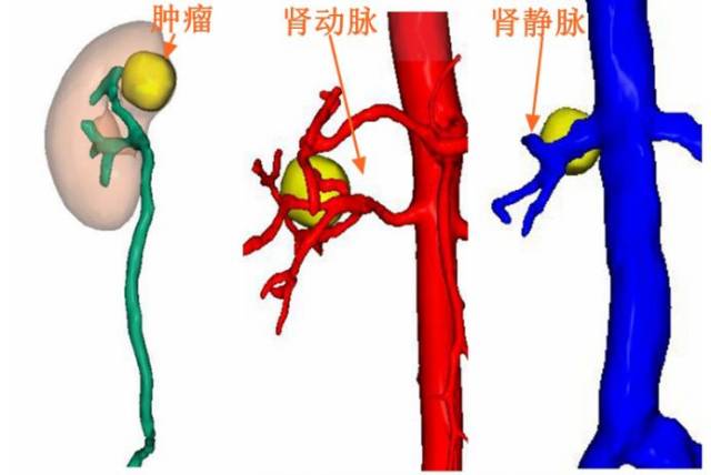 清晰,直觀,立體地展現了腫瘤與腎竇血管及集合系統的三維解剖結構,為