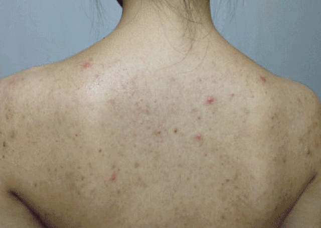 后背不停的长痘痘怎么回事?把螨虫"铲"出来,美背自然回来!