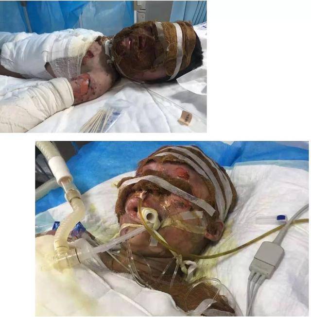 情深似海 12岁姐姐火灾中将5岁弟弟护在怀中 烧伤严重不幸去世