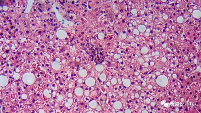 能够准确定量描述肝细胞脂肪变性的程度与面积的唯有肝穿刺病理诊断