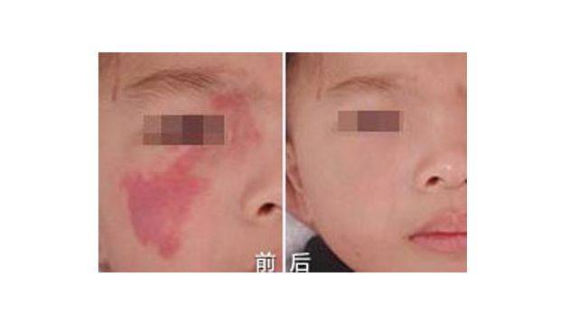 鲜红斑痣光动力