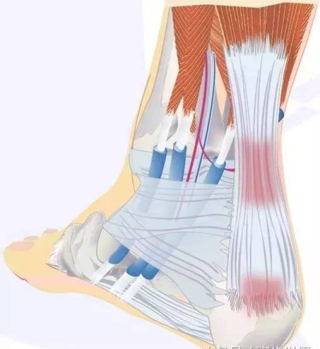 跑步者經常飽受跟腱炎之苦.