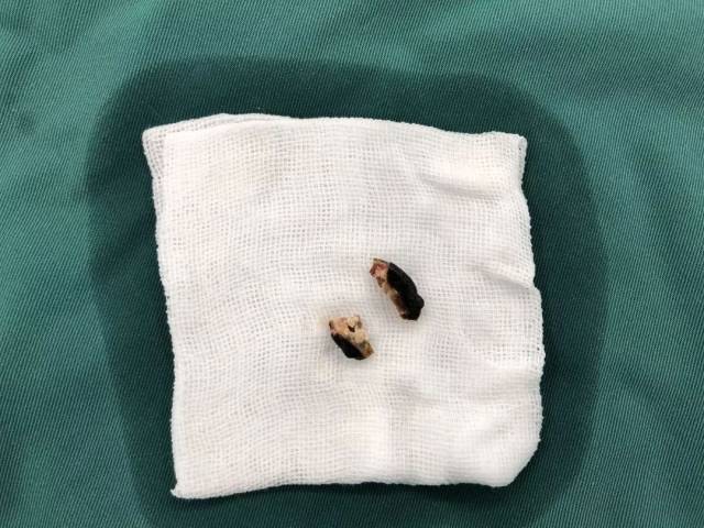 接到通知后,耳鼻喉二科,手术室,麻醉科医护团队快速为孩子完善各项术