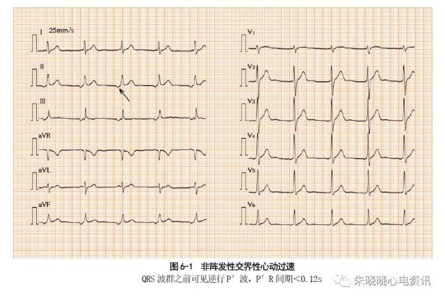 ② qrs波群前无p波而于qrs之后出现逆行p′波(图6-2),rp′间期 0.20s