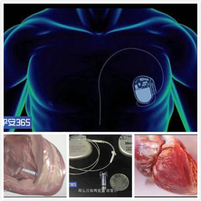 生活萬歲 | 什麼樣的患者需要佩戴心臟起搏器?