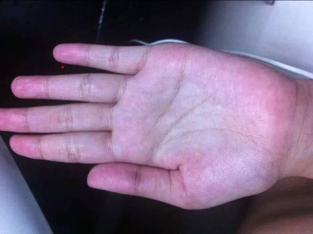 提醒:这3种"症状",不是皮肤问题,而是肝脏的"求救"信号!