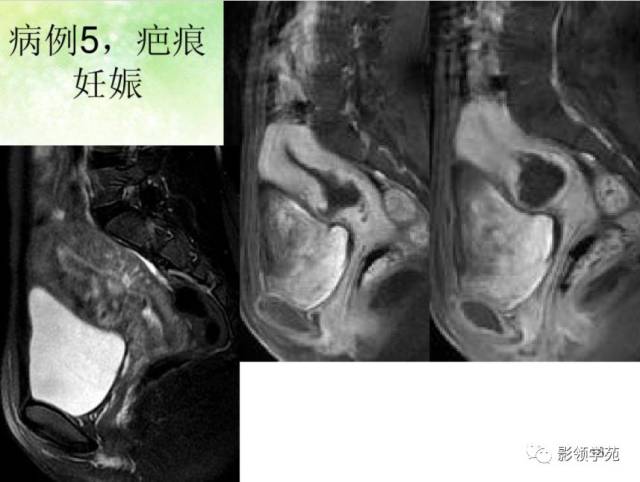 子宫疤痕与疤痕妊娠的mri诊断