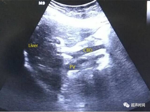 超声典型病例:胆囊切除术后又见胆囊