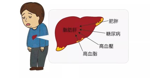 脂肪肝会连累血糖糖友患脂肪肝概率高