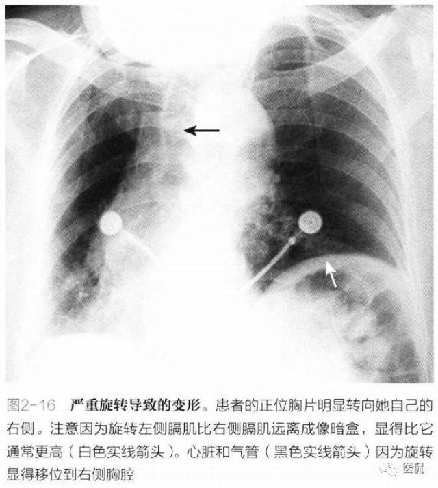 一张胸片拍的是否合格?这5个因素很重要  医学影像每日笔记53