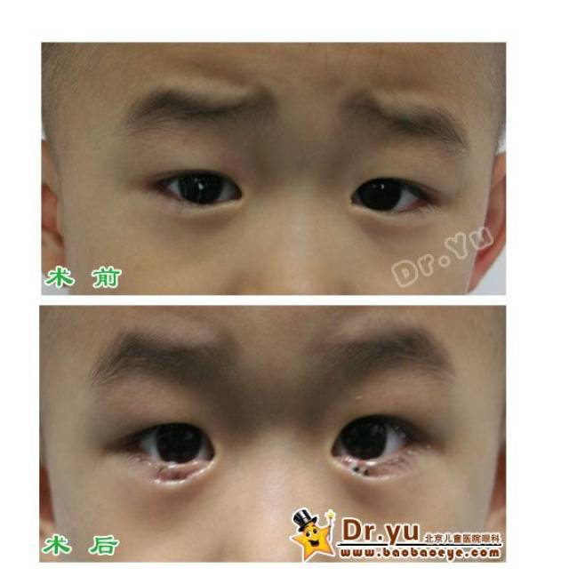 倒睫 内翻何时手术好?(附手术照片) (原创)