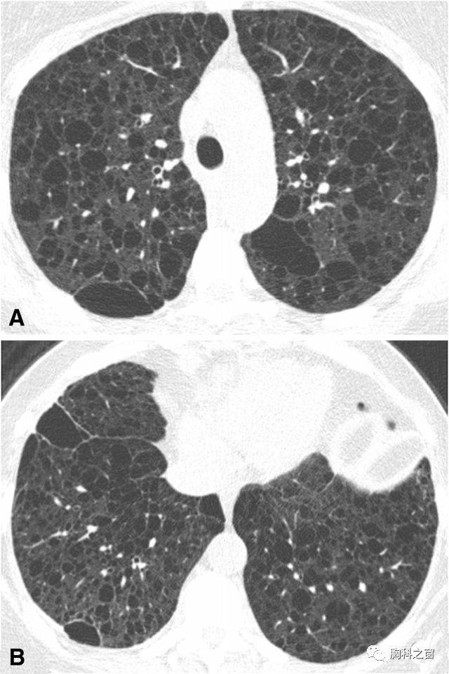 上肺野(a)及下肺野(b)轴位ct肺窗图示两肺弥漫均匀分布多发薄壁囊肿