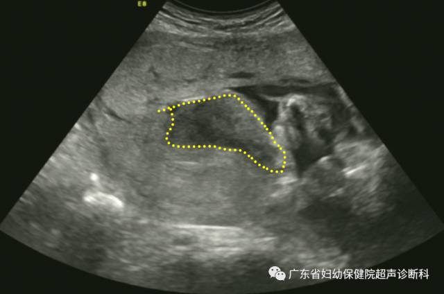 胎盘早剥超声诊断图片