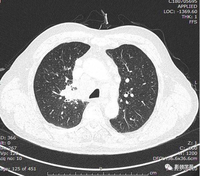 咳白色黏痰,右上肺尖段見不規則結節——小細胞惡性腫瘤_手機搜狐網