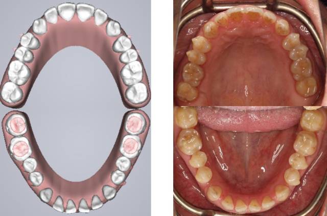 第14步  Ⅲ类颌间牵引的应用:16,26,33,43粘舌侧扣,进行Ⅲ类颌间牵引
