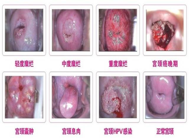 宫颈癌晚期 搜狐网
