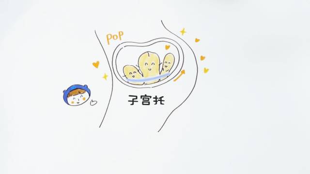 子宫托的使用方法图解图片