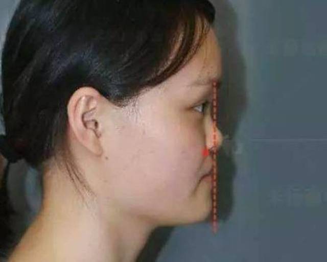 还有一种常见的鼻基底凹陷,指的是鼻翼两侧的凹陷