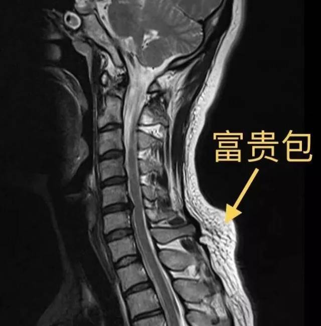 富贵包颈椎图片图片