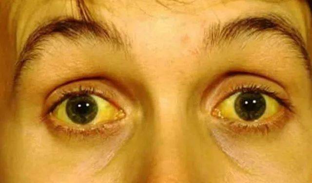 黄疸性肝炎眼睛图片