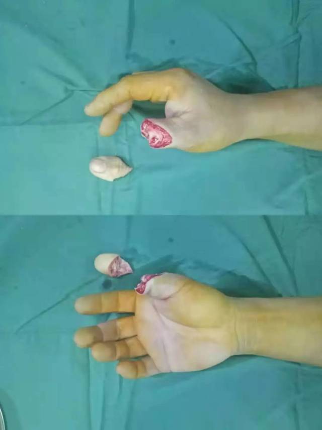 由于拇指在发挥手部功能中最为重要,为了尽可能增大患者断指再植生存