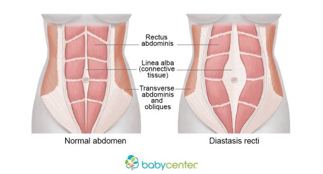 下面正常腹直肌(左)与腹直肌分离(右)两种情况的对比图