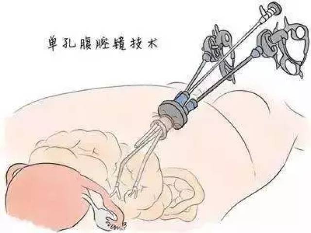 一,外阴癌的淋巴结转移