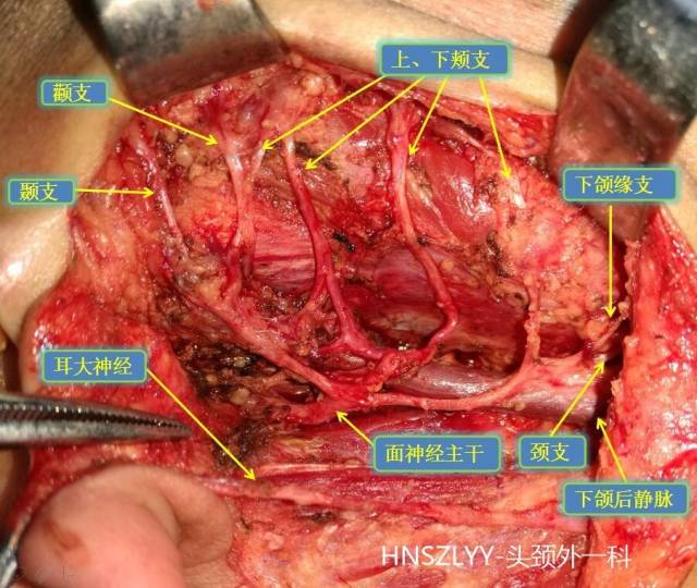 腮腺切除图片