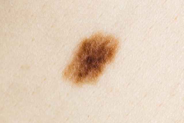 如果你有这几种痣那就要小心了医生说这些痣有可能癌变