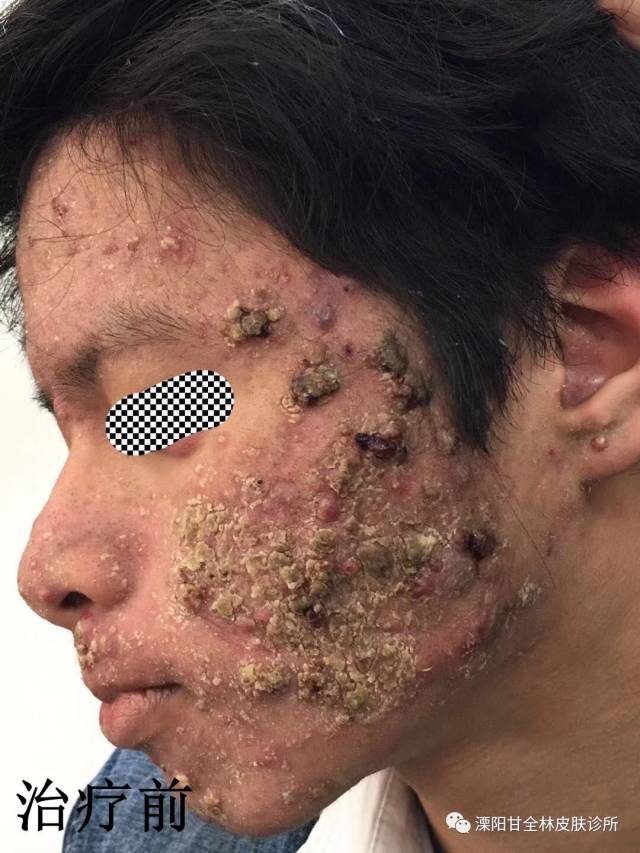 为什么痘痘总是反复的长?