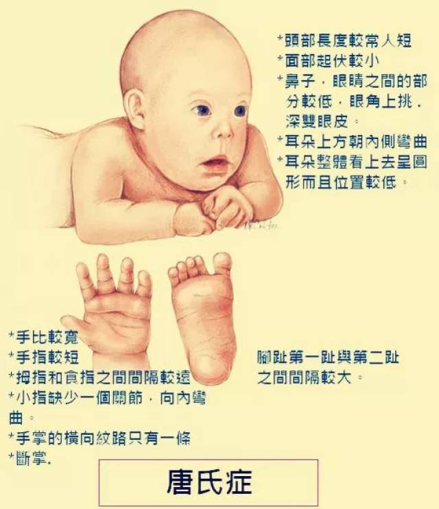 唐氏婴儿脚的图片图片