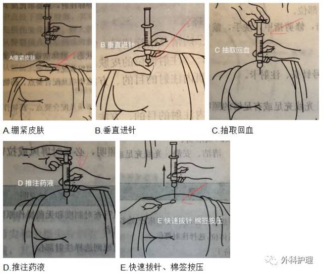 骶髂螺钉进针点图片