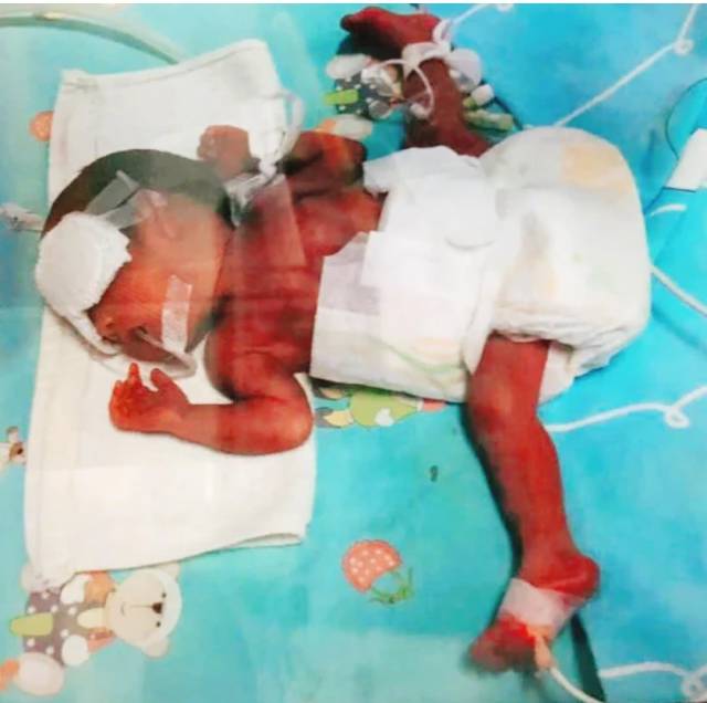 23孕周宫口已开高位破水,硬是挺到29周,生下2.6斤早产儿_手机搜狐网