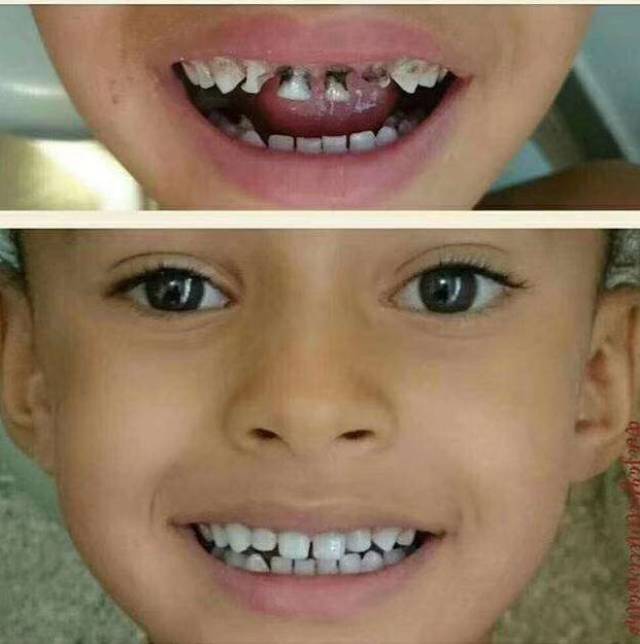 【牙医】预警,不得不给家长们看看这些腐蚀掉的乳牙照片!